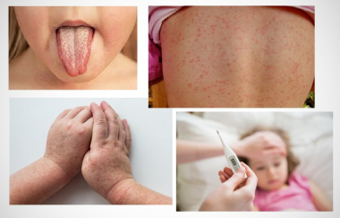 Скарлатина